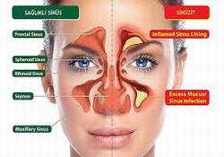 Sinüzit Ciddi Hastalıkların Habercisi